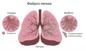 Фиброма и беременность: важные аспекты здоровья