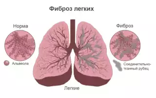 Фиброма и беременность: важные аспекты здоровья