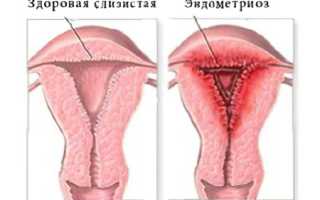 Эндометриоз матки – что это такое и как лечить? Полное руководство.
