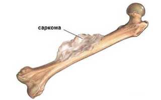 Саркома кости: причины и лечение