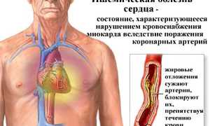 Причины, симптомы и лечение ишемии сердца: важные аспекты здоровья