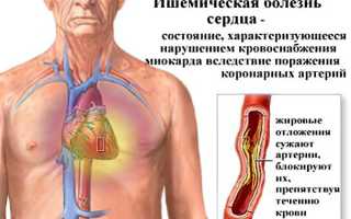 Причины, симптомы и лечение ишемии сердца: важные аспекты здоровья