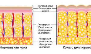 Целлюлит на бедрах и ягодицах: причины и методы борьбы
