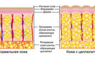 Целлюлит на бедрах и ягодицах: причины и методы борьбы