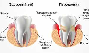 Степени и симптомы пародонтита: важные аспекты для понимания