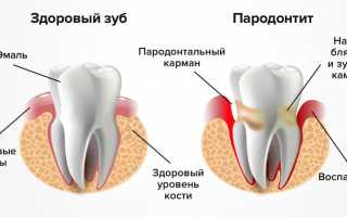 Степени и симптомы пародонтита: важные аспекты для понимания