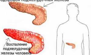 Причины, симптомы, лечение воспаления поджелудочной железы у взрослых
