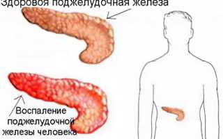 Причины, симптомы, лечение воспаления поджелудочной железы у взрослых