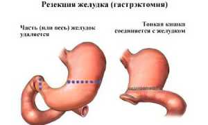 Операция по уменьшению желудка для похудения и здоровья