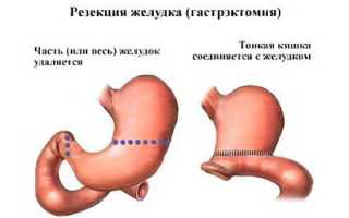 Операция по уменьшению желудка для похудения и здоровья