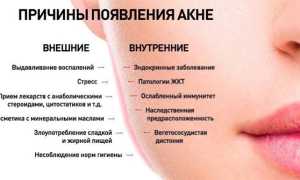 Причины появления и современные подходы в лечении акне у подростков