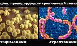 Тонзиллит: причины, симптомы и лечение, важные рекомендации