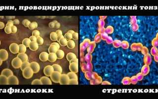 Тонзиллит: причины, симптомы и лечение, важные рекомендации