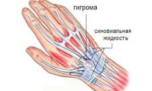 Гигрома запястья: причины и лечение
