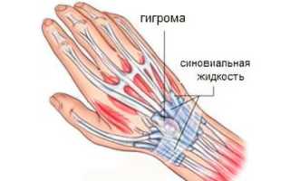 Гигрома запястья: причины и лечение