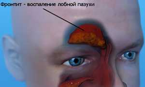 Фронтит: симптомы и лечение у взрослых