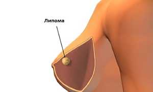 Липома молочной железы: причины и лечение