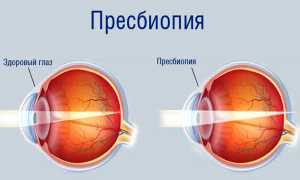 Возрастная дальнозоркость – что делать для улучшения зрения?