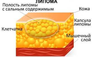 Липома – что это такое и как лечить? Полное руководство.