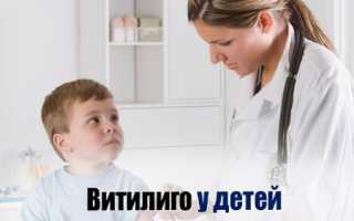 Причины, симптомы и лечение витилиго у детей: важные аспекты