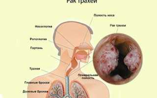 Рак трахеи: причины, симптомы и лечение