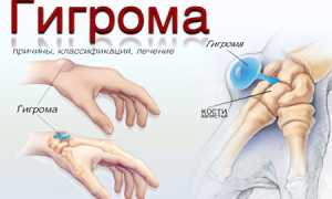 Гигрома: причины и лечение заболевания