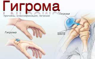 Гигрома: причины и лечение заболевания