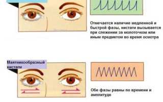 Как лечить горизонтальный нистагм