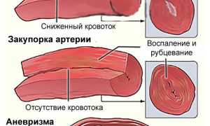 Васкулит: причины, симптомы и лечение заболевания