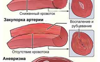 Васкулит: причины, симптомы и лечение заболевания