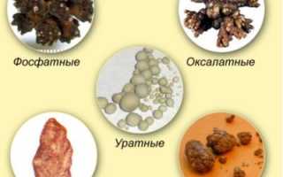 Уратные камни в почках