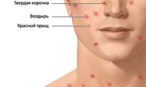 Ветряная оспа: симптомы и лечение у детей