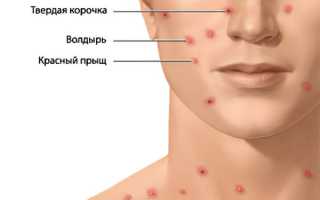 Ветряная оспа: симптомы и лечение у детей