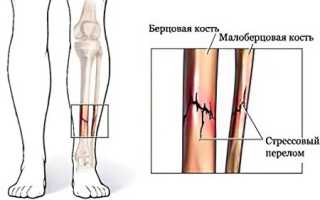 Переломы малой берцовой кости: причины и лечение