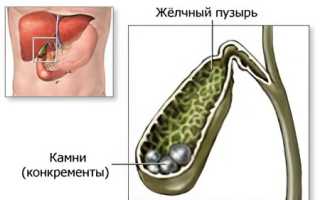 Причины, симптомы и методы лечения камней в желчном пузыре: полезная информация для пациентов