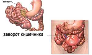 Заворот кишок: причины, симптомы и лечение, важные аспекты