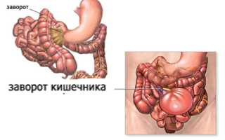 Заворот кишок: причины, симптомы и лечение, важные аспекты