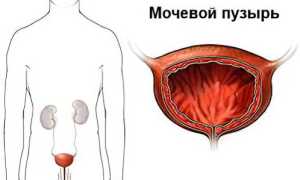 Причины и симптомы воспаления мочевого пузыря у женщин