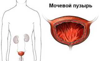 Причины и симптомы воспаления мочевого пузыря у женщин