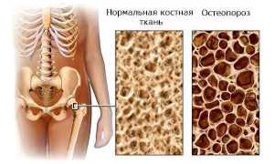 Причины, симптомы и лечение остеопороза, профилактика для здоровья