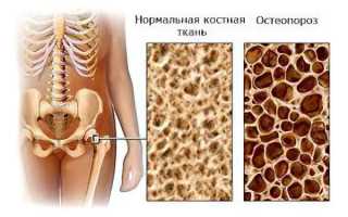 Причины, симптомы и лечение остеопороза, профилактика для здоровья