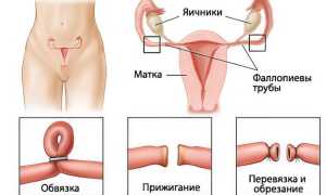 Перевязка маточных труб: виды, показания, эффект и последствия