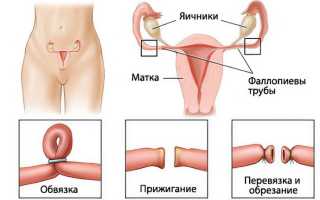 Перевязка маточных труб: виды, показания, эффект и последствия