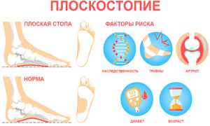 Плоскостопие: виды, стадии, симптомы и лечение для здоровья ног