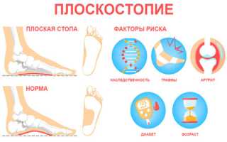 Плоскостопие: виды, стадии, симптомы и лечение для здоровья ног