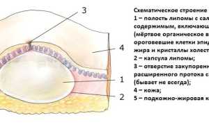 Причины, симптомы и лечение жировика на теле