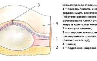 Причины, симптомы и лечение жировика на теле