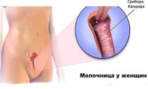 Причины, признаки и симптомы молочницы у женщин: важная информация для здоровья