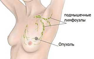 Причины, симптомы и лечение кисты молочной железы: важные аспекты