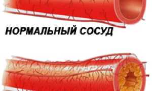 Причины, симптомы, диагностика и методы лечения атеросклероза у пациентов
